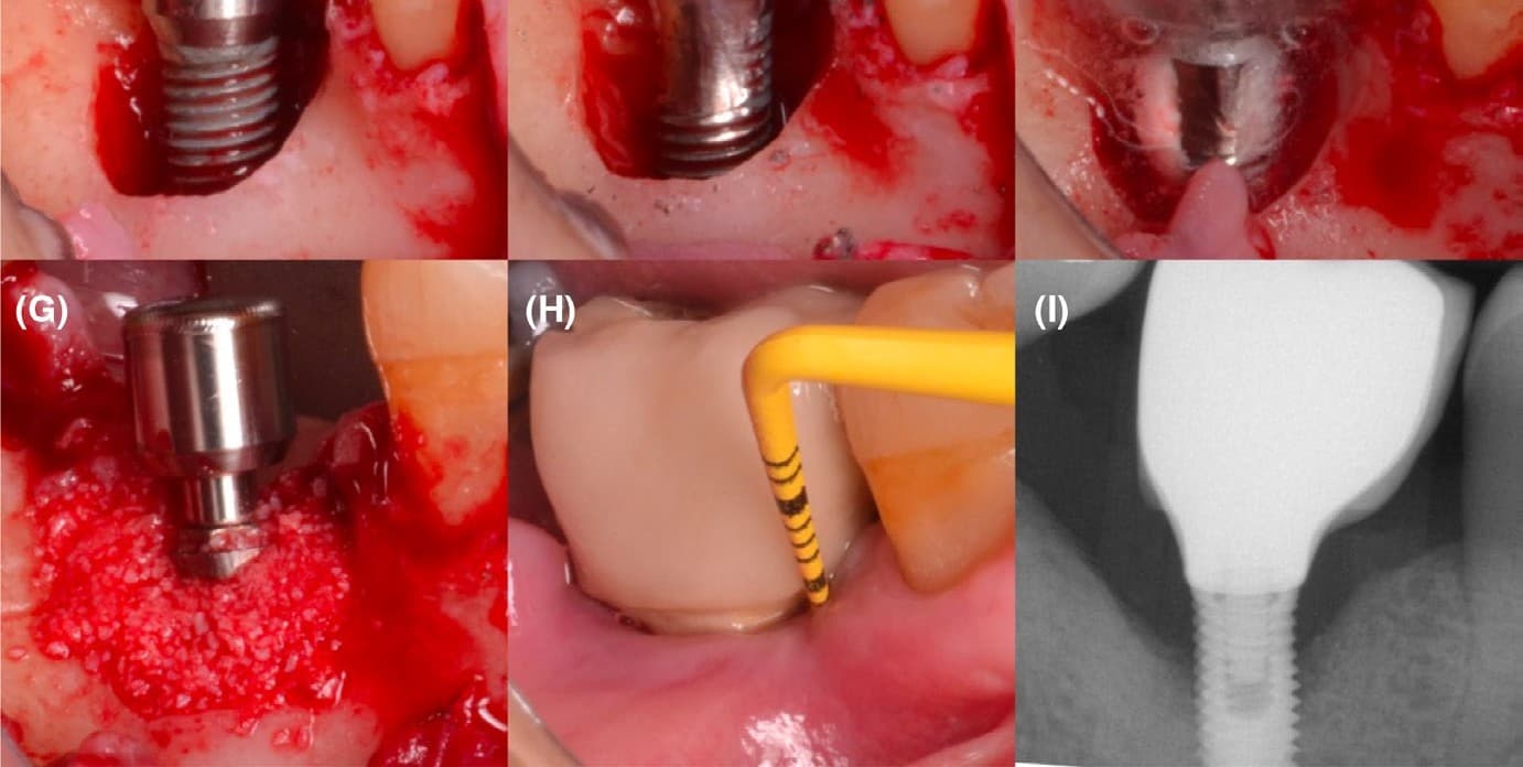 Beyond Antimicrobials: The Emerging Role of Biological Modulation in Inflammatory Implant Environments