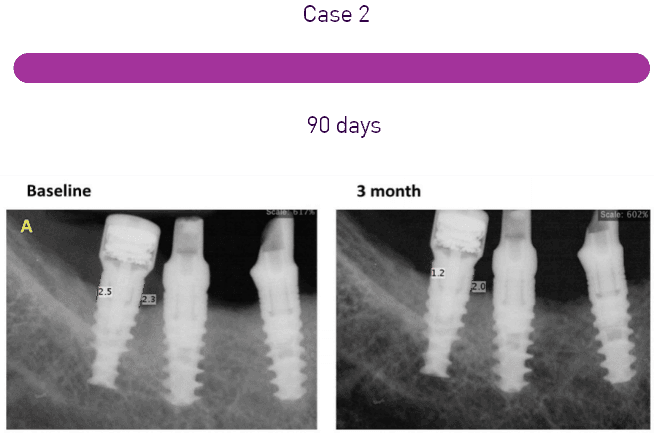 Exploring the Efficacy of Reconstructive Techniques in Peri-Implantitis Treatment: A Systematic Review