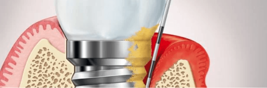 Peri-Implant Mucositis: The Reversible Precursor to Peri-Implantitis