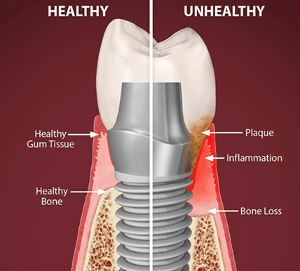 Understanding Peri-Implant Tissue: The Foundation of Successful Dental Implants