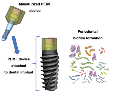 The Role of Pulsed Electromagnetic Fields in Managing Peri-Implant Conditions