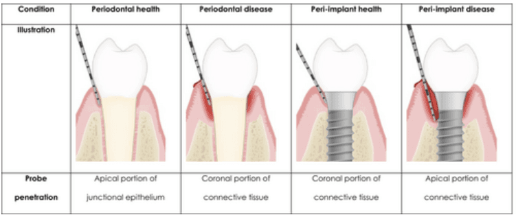 Peri-Implantitis: A Growing Concern in Dental Implantology