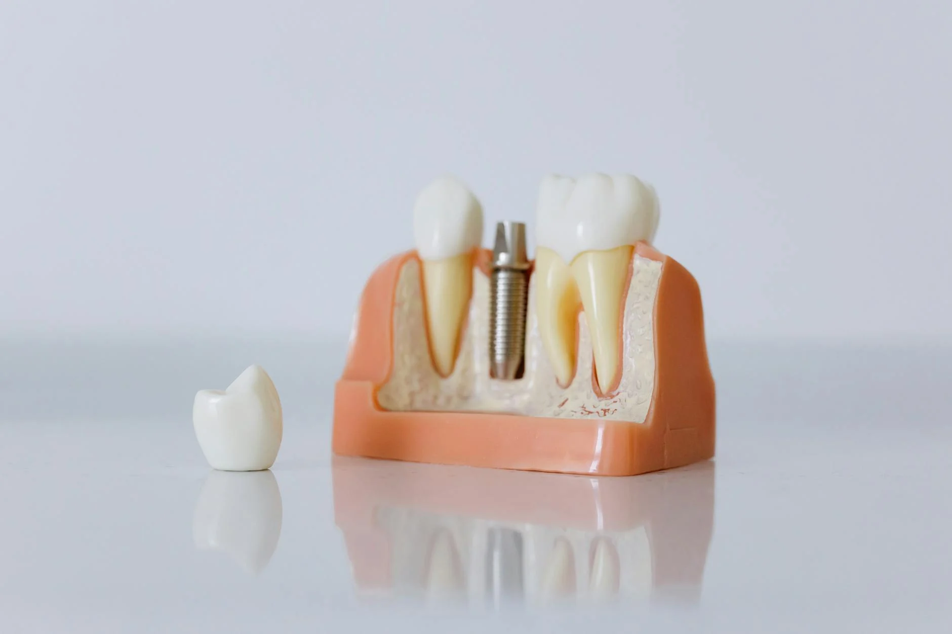 Myths and Facts About Dental Implants for Patients with Chronic Conditions