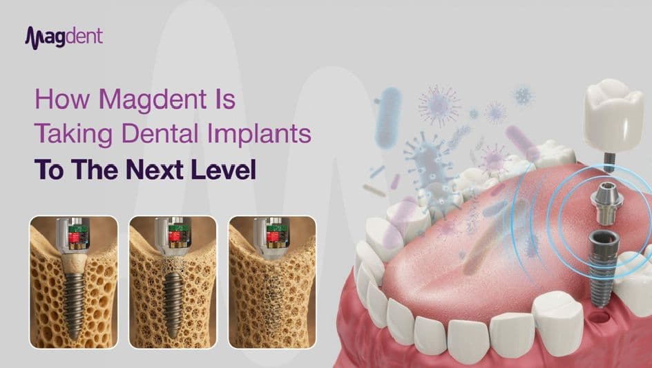 How Magdent Is Taking Dental Implants to the Next Level