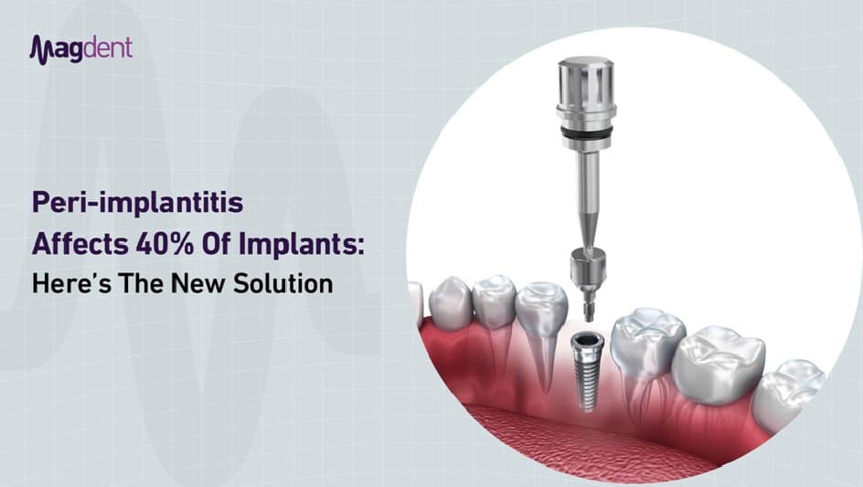 What Every Dentist Should Know About PEMF in Implant Dentistry
