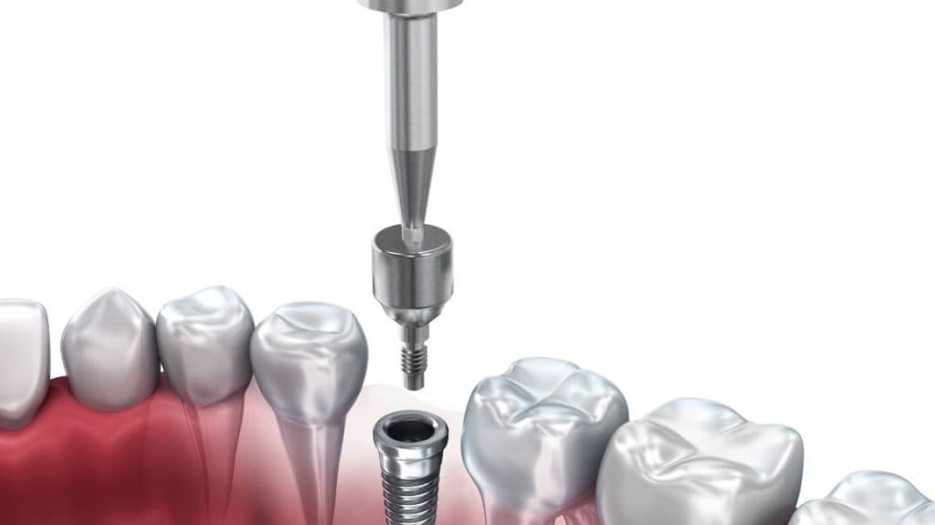 Electromagnetic Healing: The Future of Dental Implants