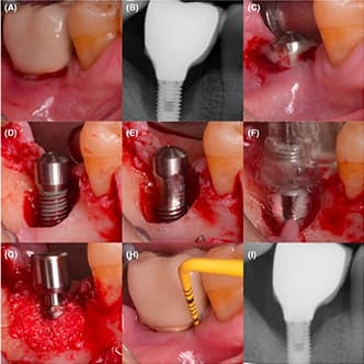 PEMF Shows Clinical Success in Peri-Implantitis Treatment: Enhancing Bone Defect Fill and Lowering IL-1β Levels Without Adjunctive Antibiotics.