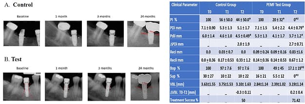 PEMF Therapy on Nonsurgical Treatment of Peri-Implantitis: 12-26 Months Follow-Up