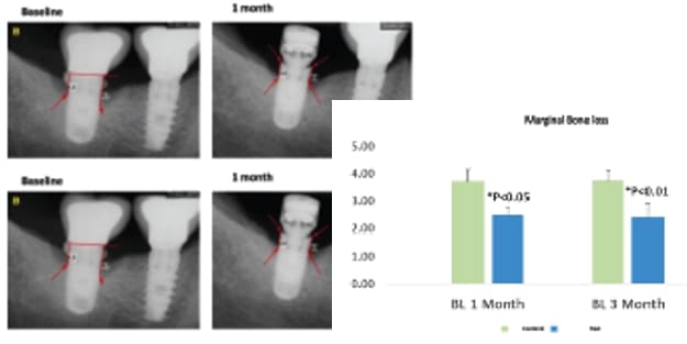 Bone Growth in Inflammatory Condition: Peri-implantitis Clinical Trial