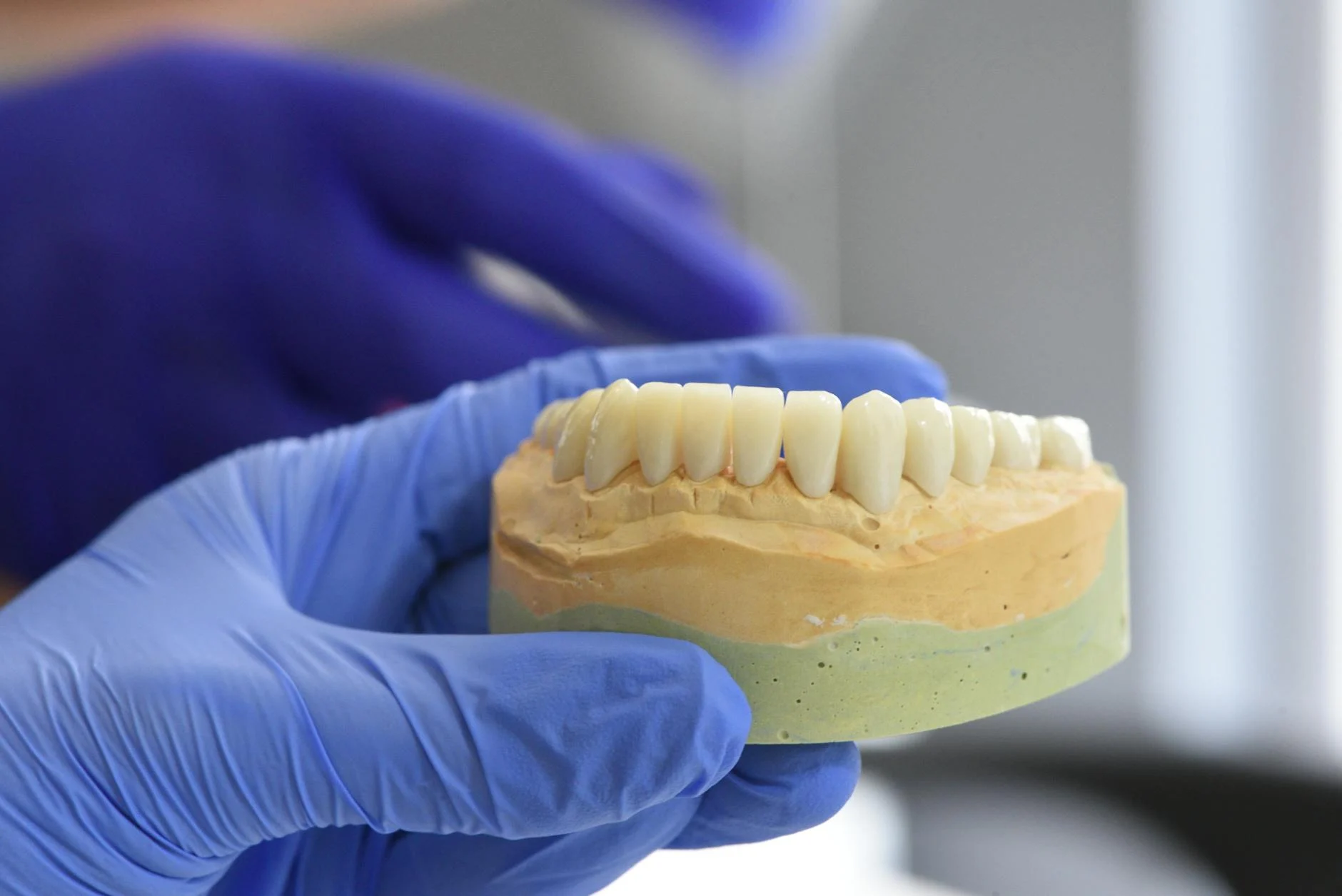 Facts About Dental Implants for Patients with Chronic Conditions