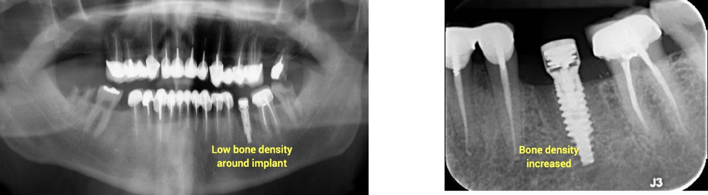 Implants & Stable Bridge, Healthy Patient | Clinical Research