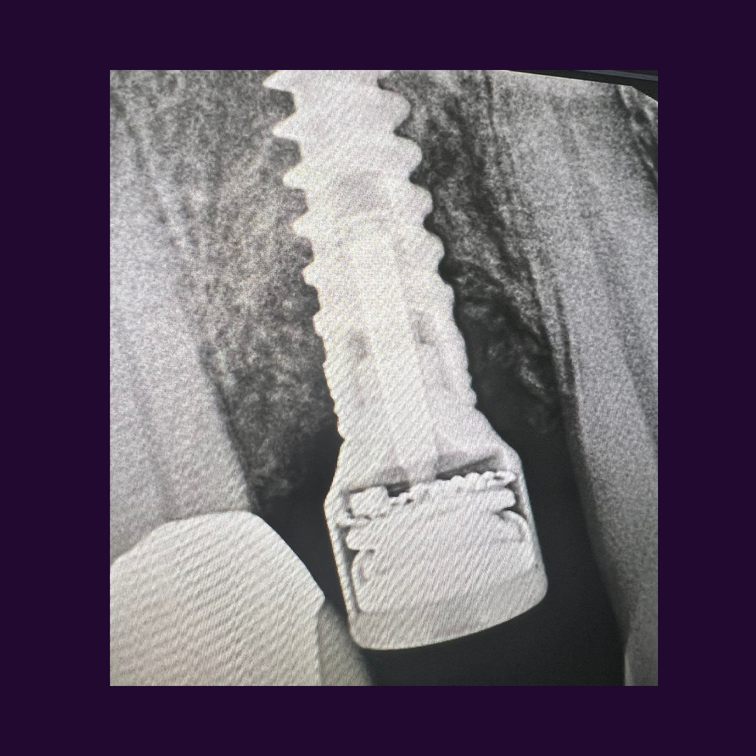 Peri-Implantitis Treatment: The Efficacy of Surgical Methods and the Breakthrough of Magdent’s PEMF Technology